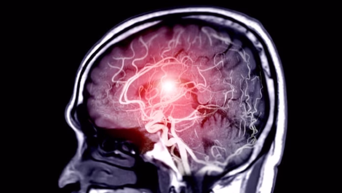 Niciun beneficiu al EVT în accidentul vascular cerebral cu ocluzie a vaselor medii